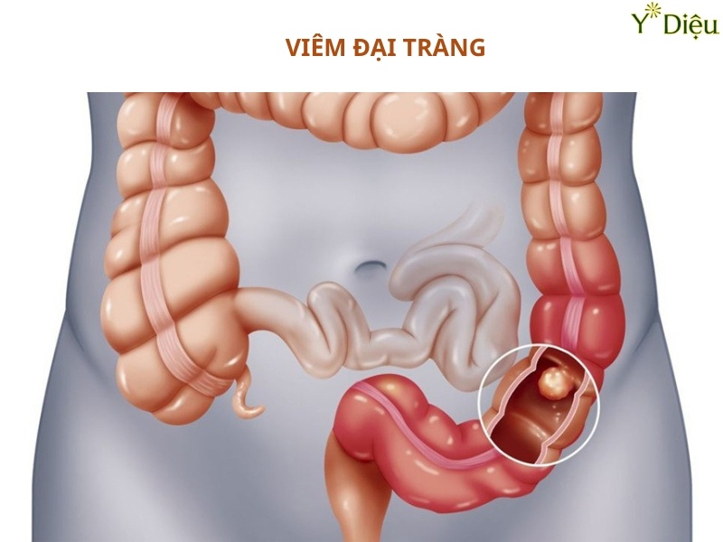 Viêm đại tràng là tình trạng viêm xảy ra tại lớp niêm mạc của đại tràng.